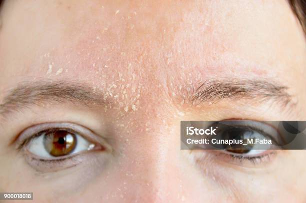 Woman With Atopic Dermatitis Stock Photo - Download Image Now - Skin, Dry, Peel - Plant Part
