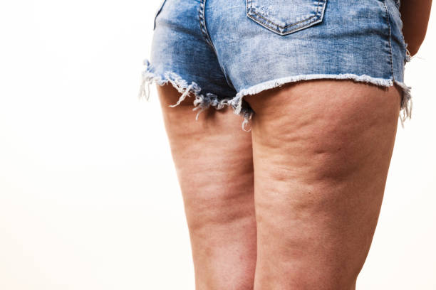 piernas de mujer con celulitis piel - celulitis tipos de piel fotografías e imágenes de stock