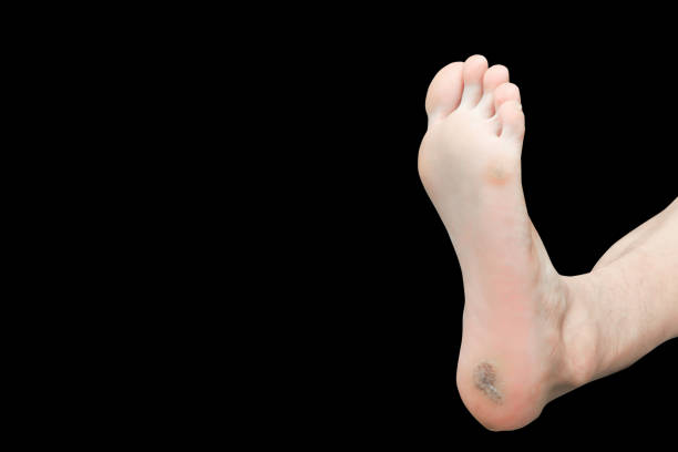 istock foot corn isolated on black background with clipping path 900374614