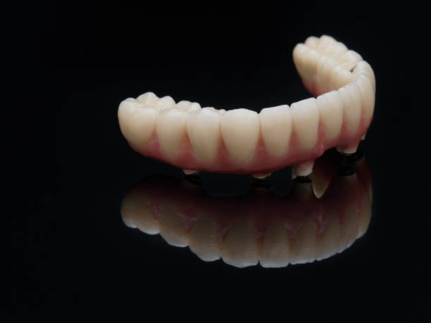 dentale protesica inferiore completo avvitato su vetro nero - laboratory dentures dental hygiene human teeth foto e immagini stock