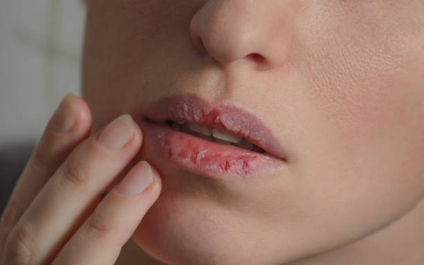 dermatillomania piel picking. mujer tiene mal hábito a sus labios. perjudicial adicciones basado en ansiedad estrés y labios secos. trastorno de la excoriación. enfermos agrietado tejido dañado. - seco fotografías e imágenes de stock