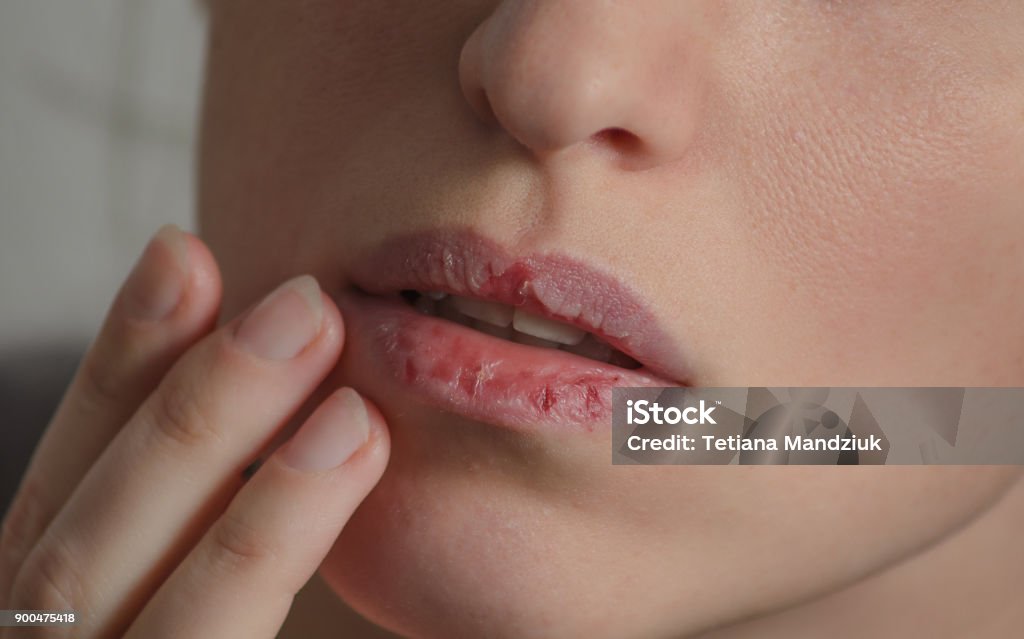 Dermatillomania skin picking. Woman has bad habit to pick her lips. Harmful addiction based on anxiety stress and dry lips. Excoriation disorder. Sick cracked damaged tissue. Dry Stock Photo