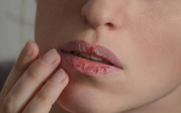 dermatillomania 皮膚採摘。女人有壞習慣去摘她的嘴唇。基於焦慮和幹唇的有害成癮。痂紊亂。受損的組織破裂 - 嘴 個照片及圖片檔
