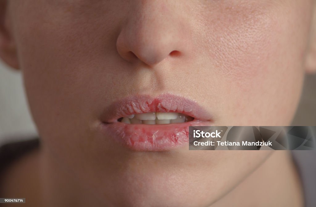 Dermatillomania skin picking. Woman has bad habit to pick her lips. Harmful addiction based on anxiety stress and dry lips. Excoriation disorder. Sick cracked damaged tissue. Human Lips Stock Photo