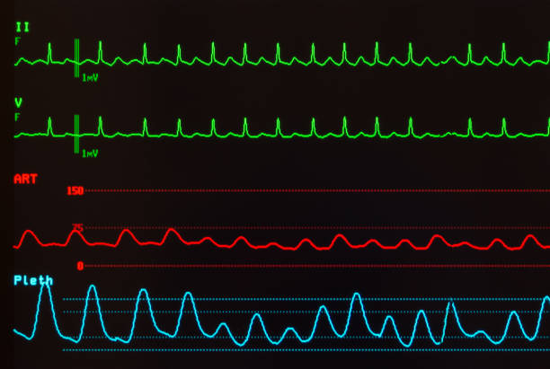 istock Atrial Flutter with Variable Conduction on Electrocardiogram, Arterial Blood Pressure and Pulse Oxymetry 900699204