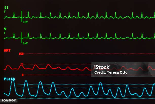 Ekg Variable Conduction Atrial Flutter With Variable Conduction On Electrocardiogram Arterial ...