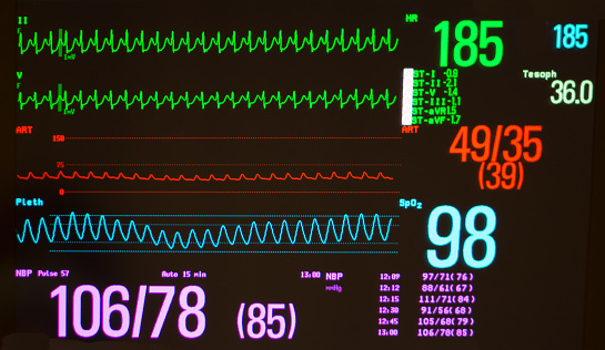 A medical monitor with a black screen showing atrioventricular node re-entrant tachycardia (AVNRT) on the green electrocardiogram lines, the arterial blood pressure on the red line and the pulse oximeter waveform on the blue line.