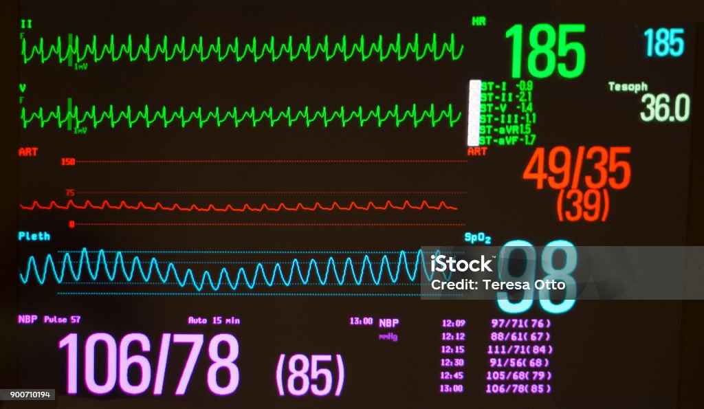 Atrioventricular Node Re-Entrant Tachycardia, Arterial Blood Pressure, Pulse Oximeter Waveform and Vital Signs on a Medical Monitor A medical monitor with a black screen showing atrioventricular node re-entrant tachycardia (AVNRT) on the green electrocardiogram lines, the arterial blood pressure on the red line and the pulse oximeter waveform on the blue line. Tachycardia Stock Photo