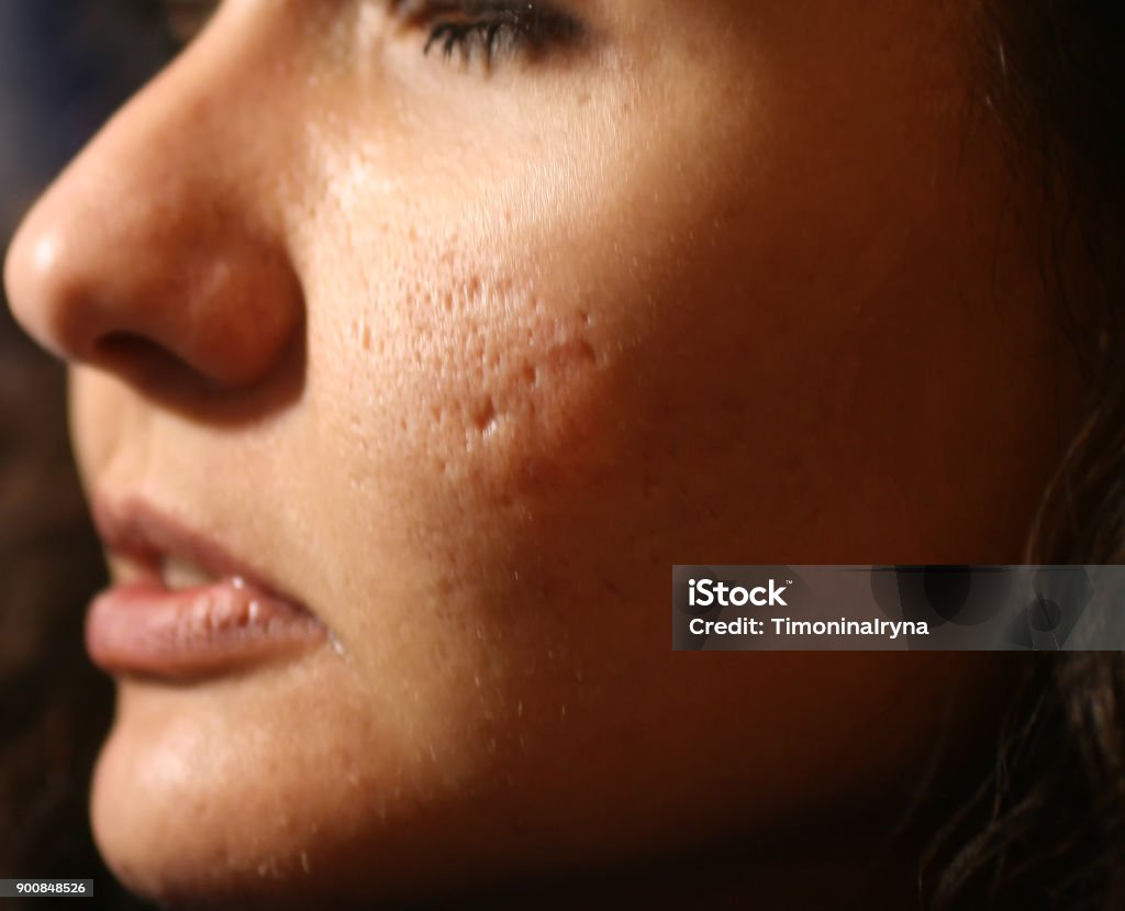 Inflamação da pele do rosto de espinhas e acne. Correção para as cicatrizes de acne - Foto de stock de Cicatriz royalty-free