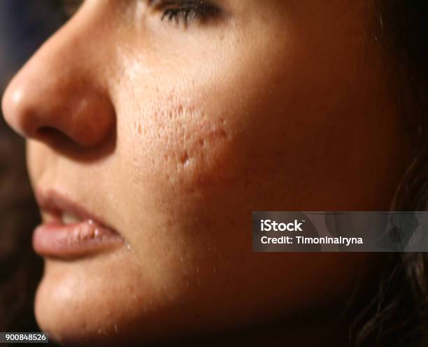 Foto de Inflamação Da Pele Do Rosto De Espinhas E Acne Correção Para As Cicatrizes De Acne e mais fotos de stock de Cicatriz