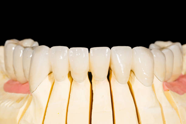 istock Dental zirconia bridge 901146378