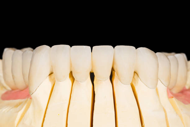 istock Dental zirconia bridge 901146470