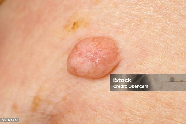 Huge Wart On Human Skin Stock Photo - Download Image Now - Wart, Human Papilloma Virus, Senior Adult
