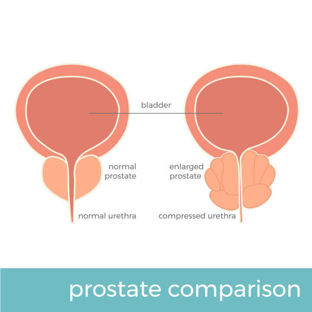 ilustrações de stock, clip art, desenhos animados e ícones de prostate comparison - erectile dysfunction