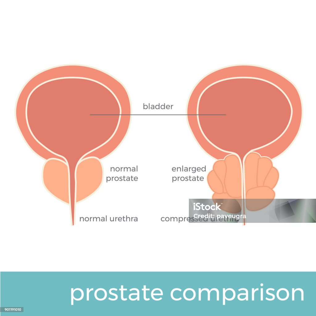 prostata jämförelse - Royaltyfri Prostatakörtel vektorgrafik