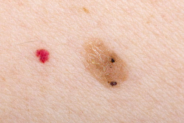 istock Nevus and cherry angioma on human skin 901257288