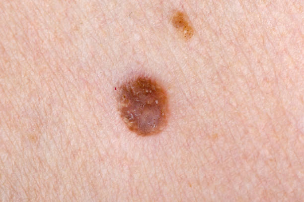 istock Nevus on human skin 901258160