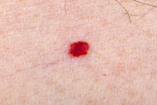 istock Cherry angioma on human skin 901260616