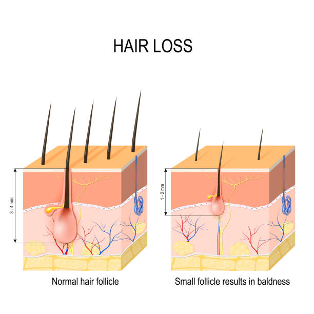 ilustrações, clipart, desenhos animados e ícones de perda de cabelo (calvície). normal do folículo de cabelo e pele com alopecia. - alopecia antes depois