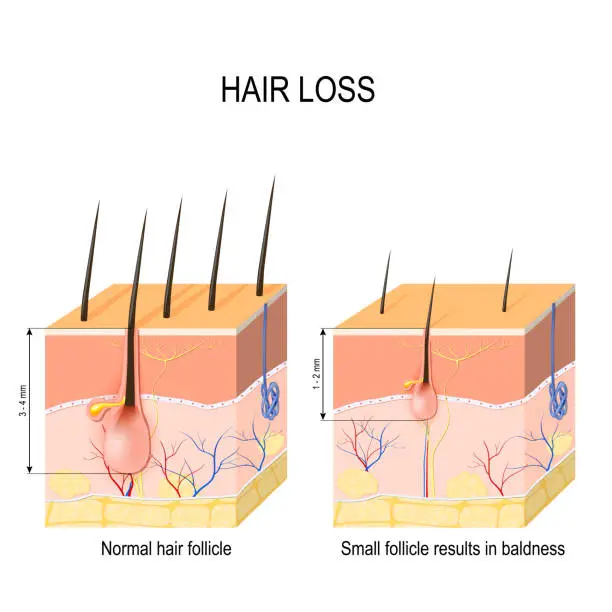 Vector illustration of Hair loss (baldness). Normal hair follicle and skin with Alopecia.