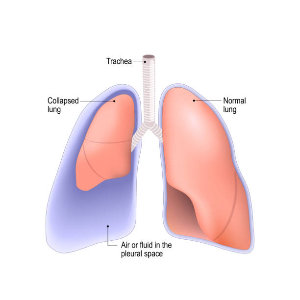 zapadnięte płuco. odmy opłucnowa, wysięk opłucnej lub empiria - pus stock illustrations
