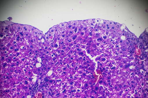 Acute ordinary hepatitis liver biopsy under light microscopy