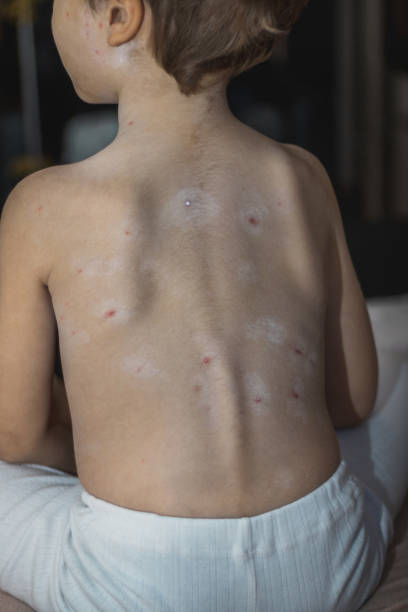 istock Little boy with Varicella disease. 902252292