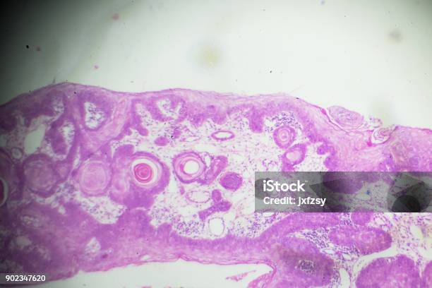 Squamous Cell Microscope Squamous Cell Carcinoma Under Microscopy Stock Photo - Download Image ...