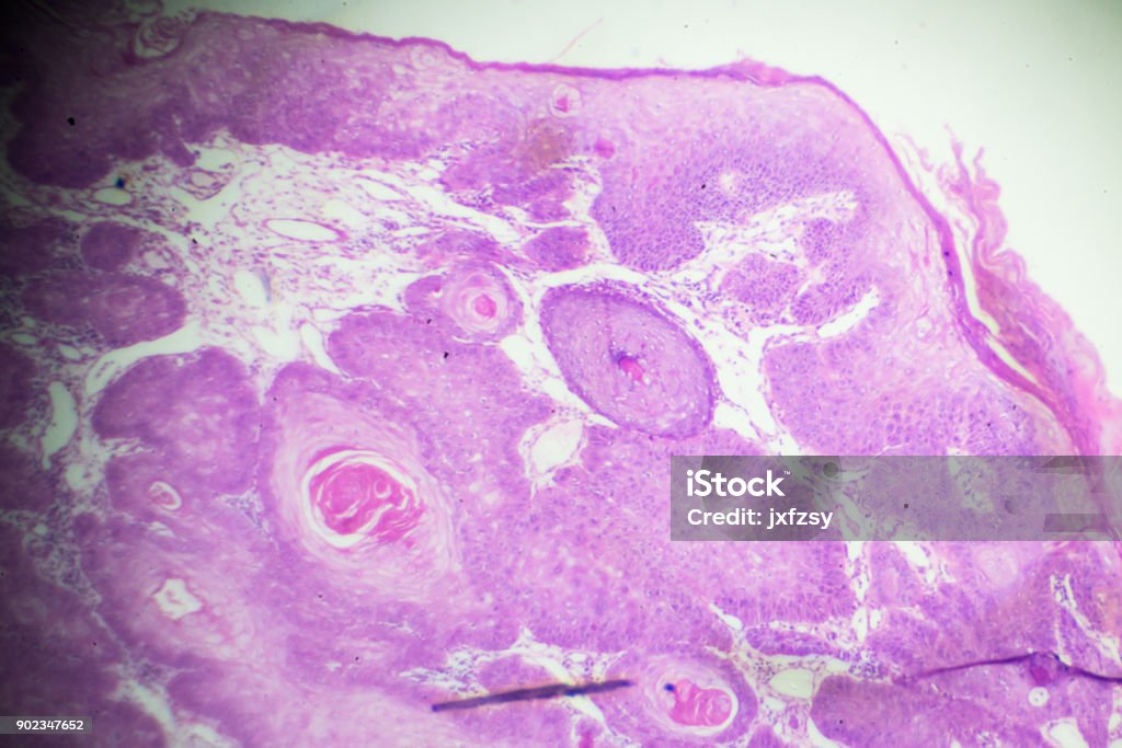 Squamous Cell Microscope Squamous Cell Carcinoma Under Microscopy Stock Photo - Download Image ...