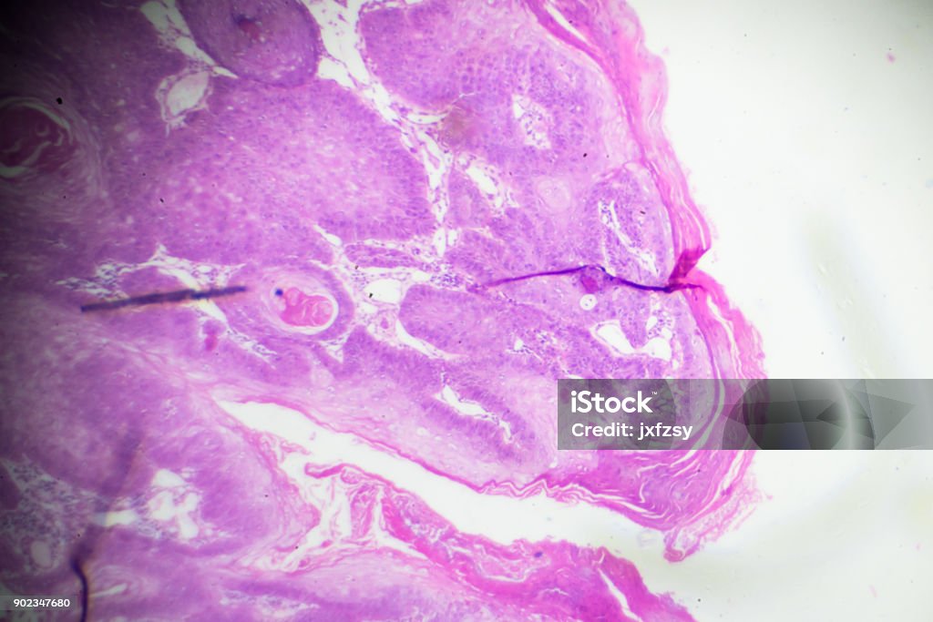 Squamous Cell Microscope Squamous Cell Carcinoma Under Microscopy Stock Photo - Download Image ...