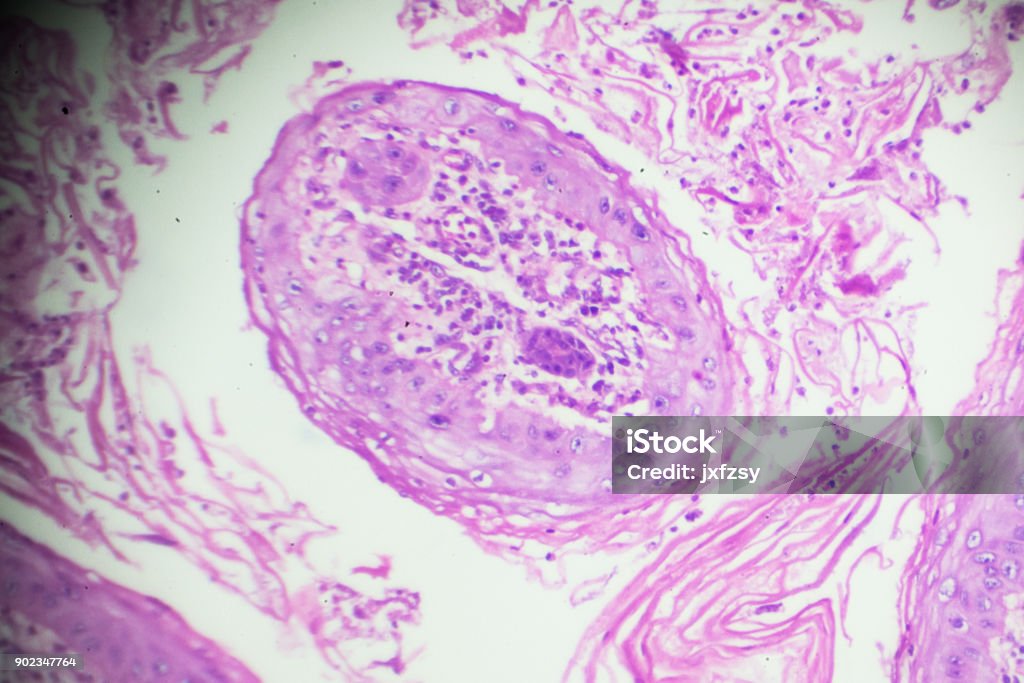 Squamous Cell Microscope Squamous Cell Carcinoma Under Microscopy Stock Photo - Download Image ...