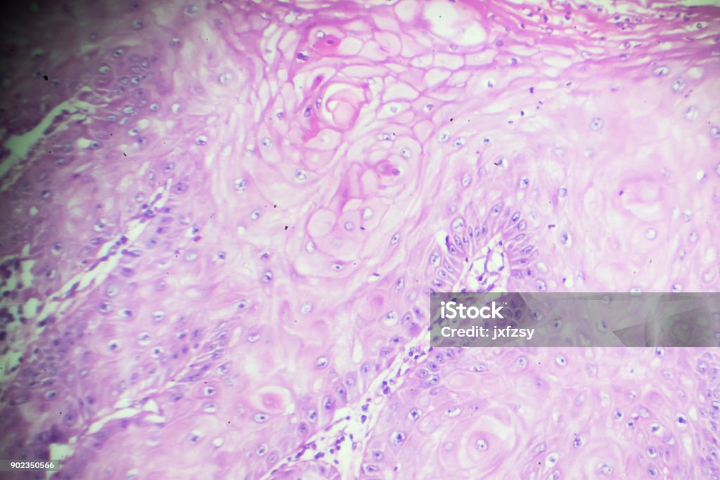 Squamous Cell Microscope Squamous Cell Carcinoma Under Microscopy Stock Photo - Download Image ...