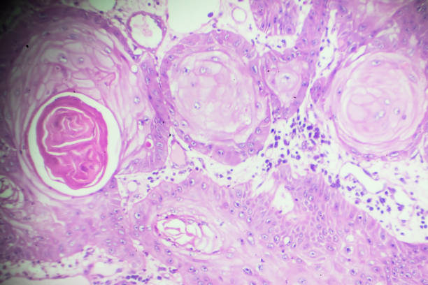 carcinoma de célula squamous bajo microscopia - laboratory healthcare and medicine cancer drug histology fotografías e imágenes de stock