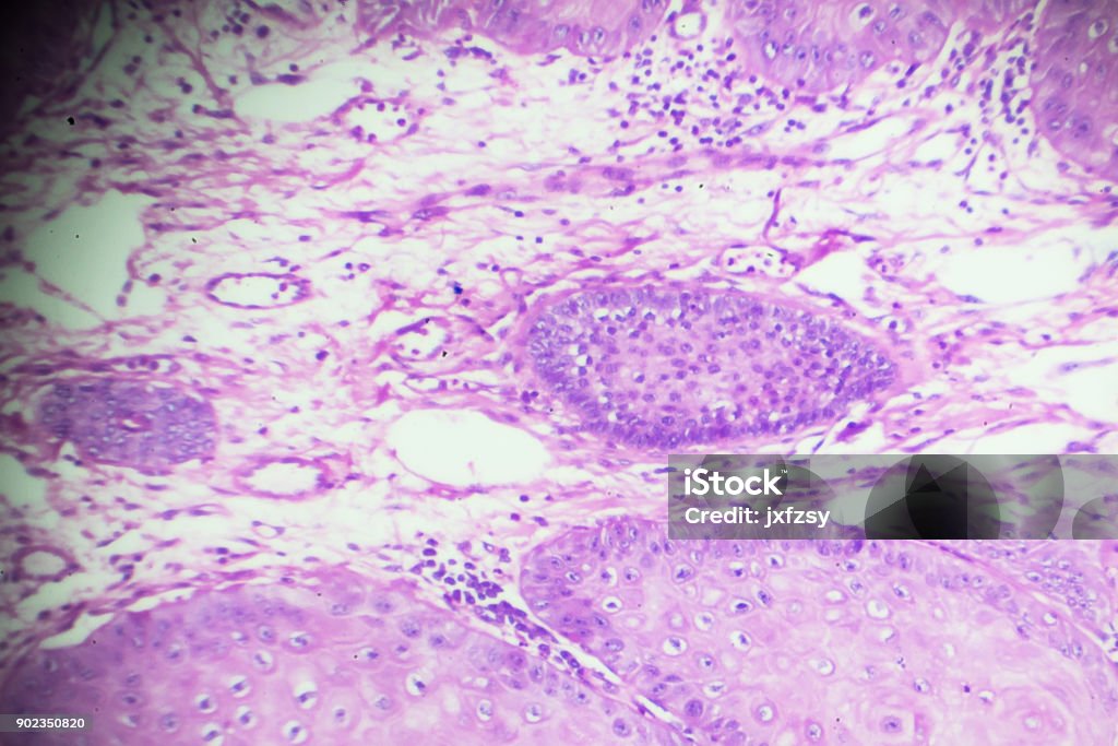 Squamous Cell Microscope Squamous Cell Carcinoma Under Microscopy Stock Photo - Download Image ...