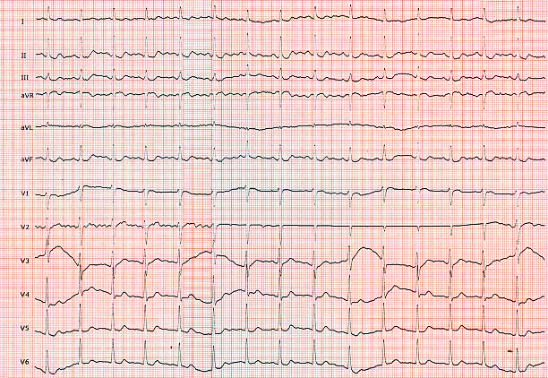 elektrokardiograph - human heart surveillance computer monitor pulse trace ストックフォトと画像