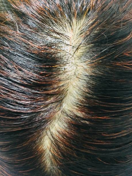istock Woman Serious Hair Loss and White Problem 902598574