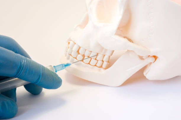 dental anestesia ou punção cisto dente conceito foto. médico dentista segurando a seringa, agulha facadas no maxilar superior do crânio acima dos dentes, seguindo o procedimento de anestesia dentária, punção de cisto - tranquilizing - fotografias e filmes do acervo