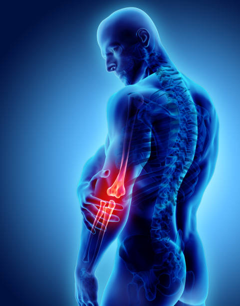 3d illustration of human elbow injury. stock photo