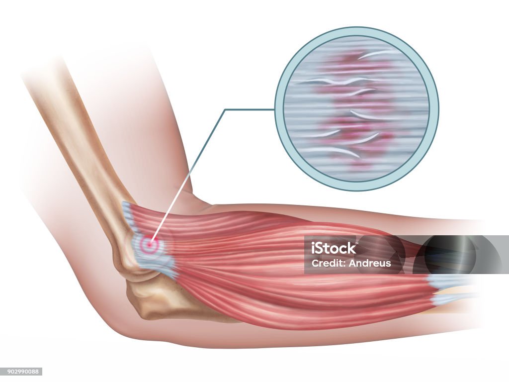外側上顆炎 - 肘のロイヤリティフリーストックイラストレーション