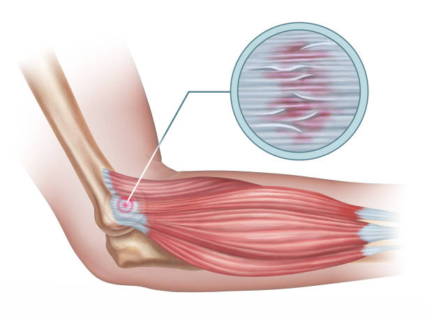 ilustrações de stock, clip art, desenhos animados e ícones de lateral epicondylitis - elbow