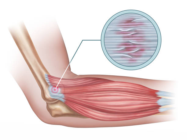 боковой эпикондилит - human muscle illustrations stock illustrations