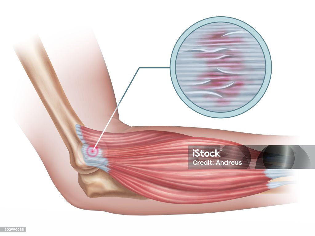 Lateral epicondylitis Tennis elbow diagram showing a detail of the damaged tendon tissue. Digital illustration. Elbow stock illustration