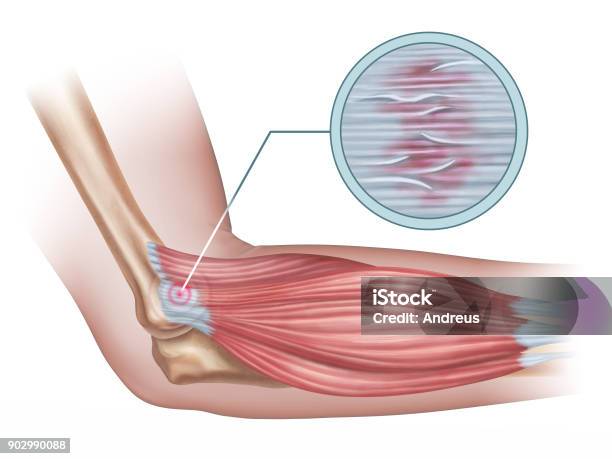 Lateral Epicondylitis Stock Illustration - Download Image Now - Elbow, Tennis, Tendon