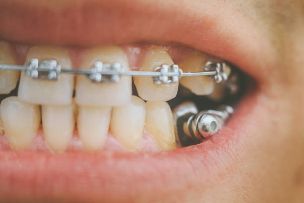 istock Dental appliance and braces 903007132
