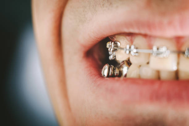 View of dental appliance for deep bite and braces attached to a young man teeth