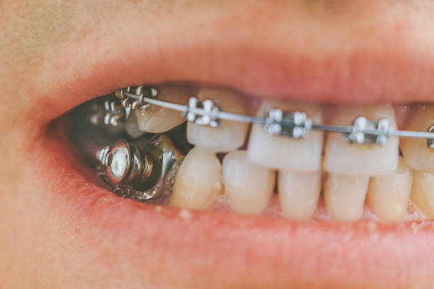 istock Dental appliance and braces 903007610
