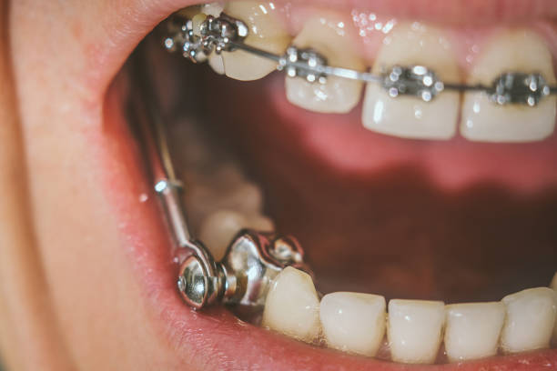 View of dental appliance for deep bite and braces attached to a young man teeth