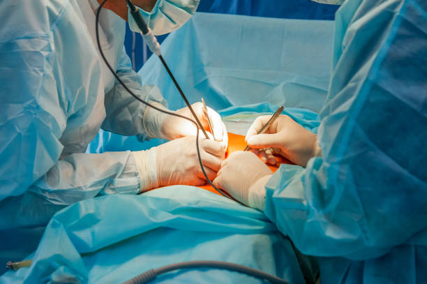 complexa operação laparoscópica em uma cavidade peritoneal é realizada em quatro mãos - abdómen - fotografias e filmes do acervo