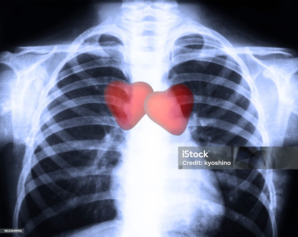 Hình Ảnh Xquang Ngực Người Bình Thường Với Trái Tim Người Đỏ Hình ...