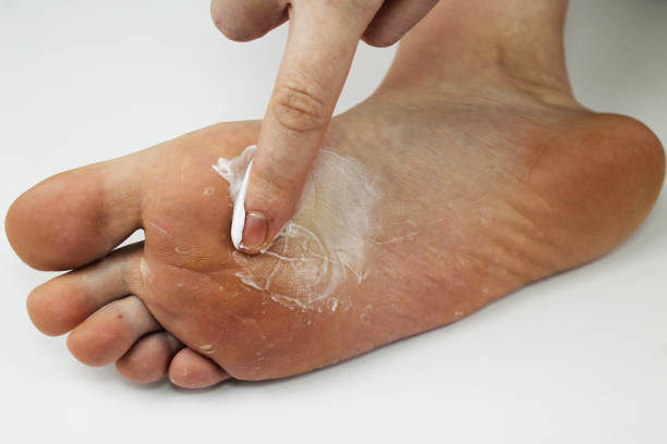 grzyb stopy z bliska, izolowany na białym tle. dermatologia koncepcja, leczenie zakażeń grzybiczych i grzybiczych u ludzi. makro wideo ludzkie stopy. aby rozmazać nogę maścią przeciwgrzybiczą - podiatry chiropody toenail human foot zdjęcia i obrazy z banku zdjęć